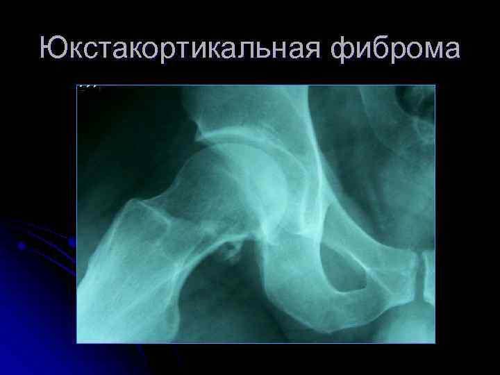 Юкстакортикальная фиброма 