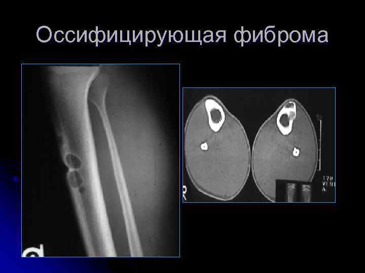 Оссифицирующая фиброма 