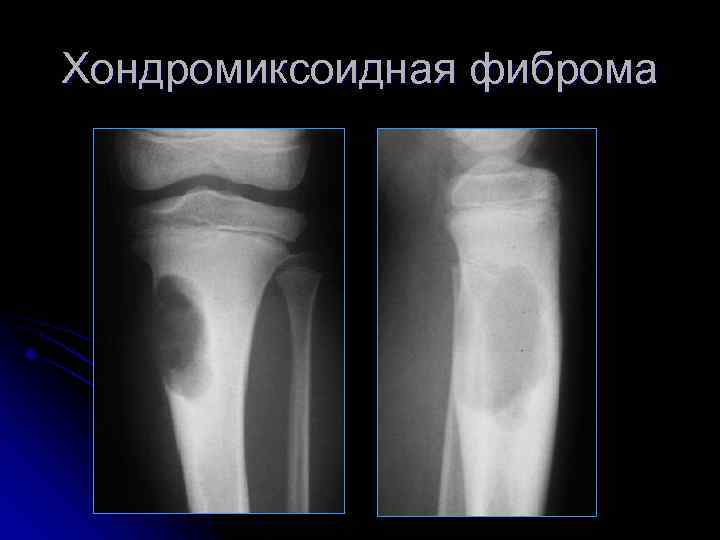 Хондромиксоидная фиброма 