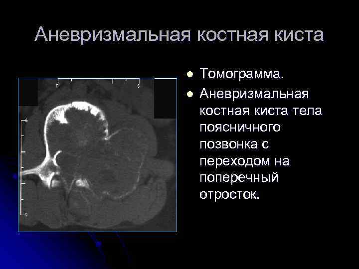 Аневризмальная костная киста l l Томограмма. Аневризмальная костная киста тела поясничного позвонка с переходом