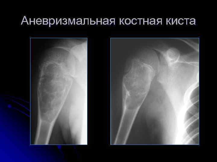 Аневризмальная костная киста 