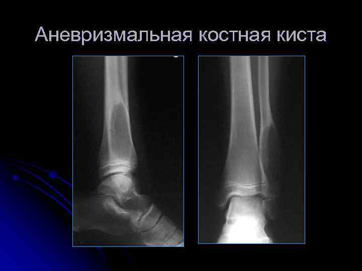 Аневризмальная костная киста 