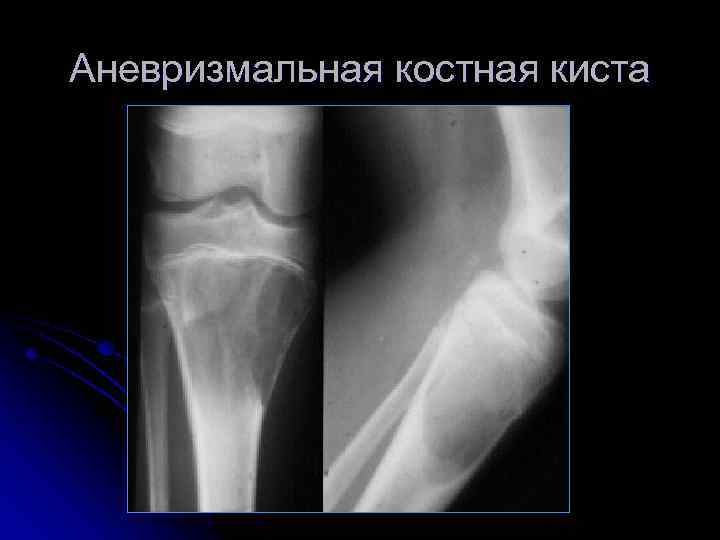 Аневризмальная костная киста 