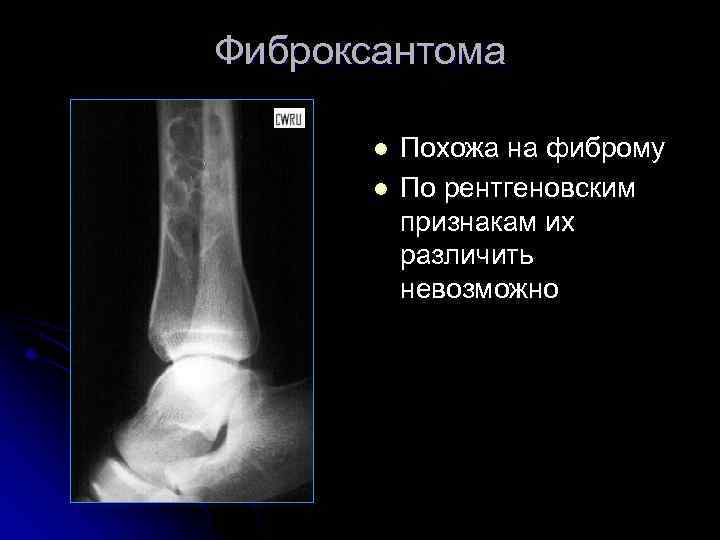 Фиброксантома l l Похожа на фиброму По рентгеновским признакам их различить невозможно 