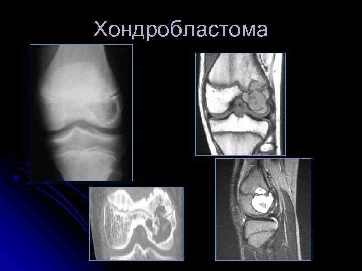 Хондробластома 