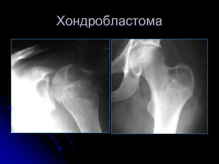 Хондробластома 