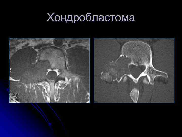 Хондробластома 