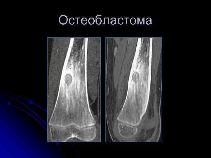 Остеобластома 