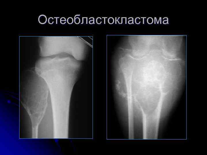 Остеобластокластома 