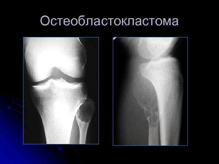 Остеобластокластома 