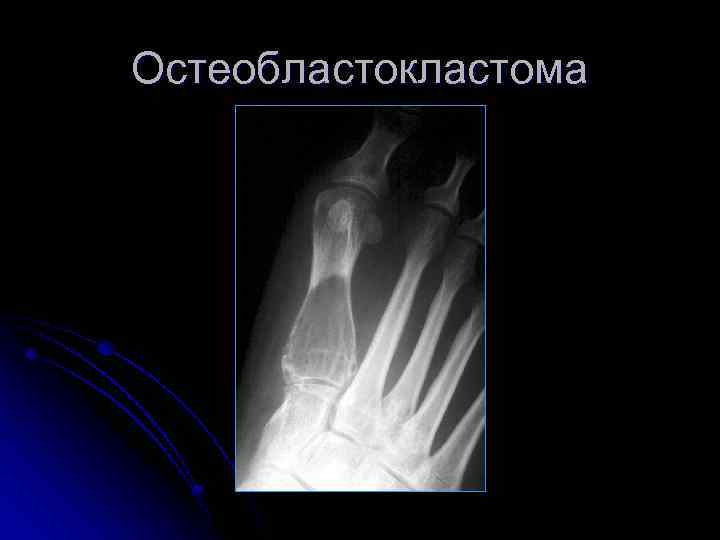 Остеобластокластома 