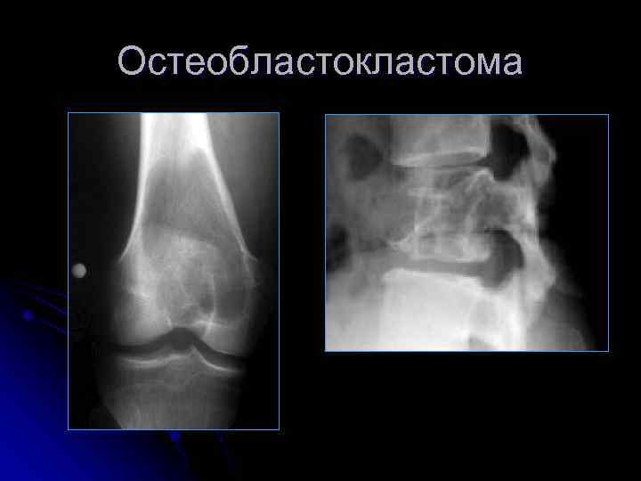Остеобластокластома 