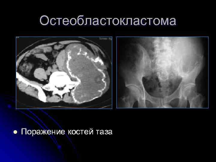Остеобластокластома l Поражение костей таза 