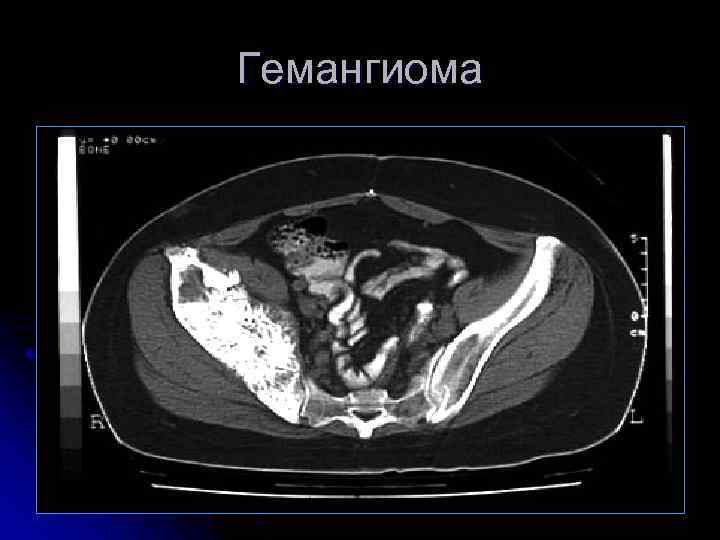 Гемангиома 