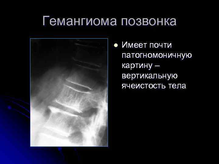 Гемангиома позвонка l Имеет почти патогномоничную картину – вертикальную ячеистость тела 