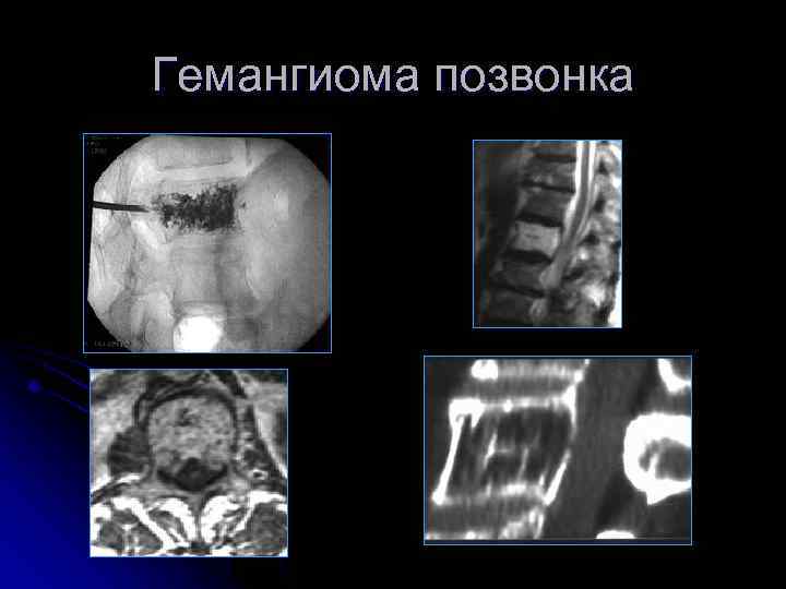 Гемангиома позвонка 