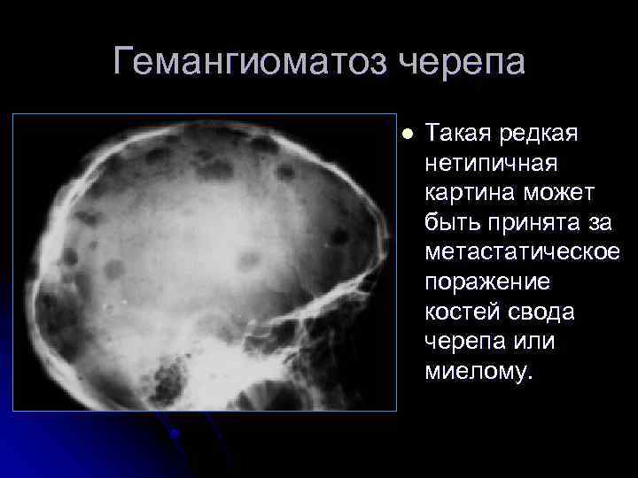 Гемангиоматоз черепа l Такая редкая нетипичная картина может быть принята за метастатическое поражение костей