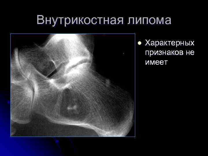 Внутрикостная липома l Характерных признаков не имеет 