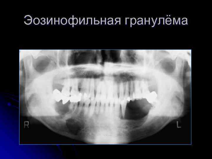 Эозинофильная гранулёма 