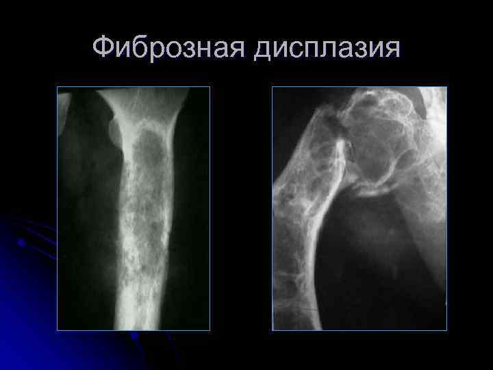 Фиброзная дисплазия 