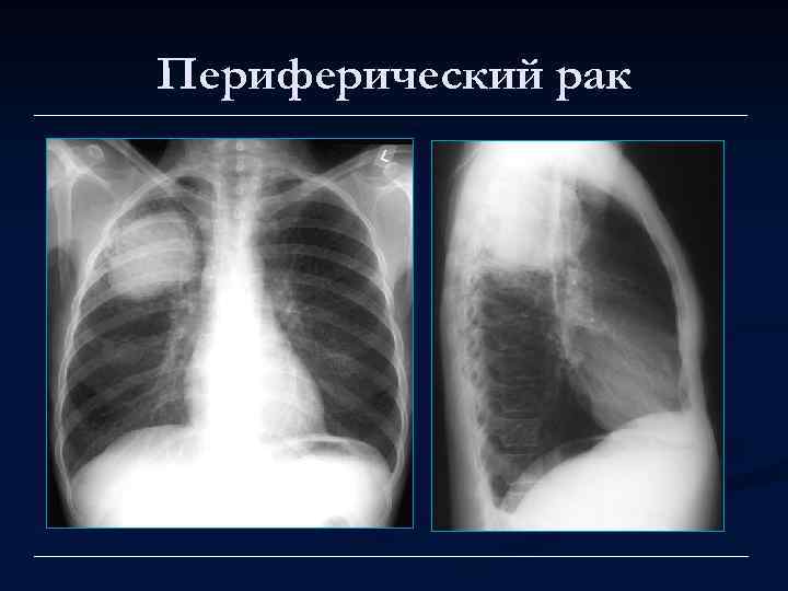 Периферический рак 