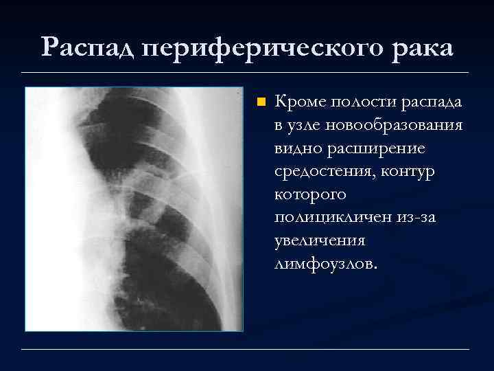 Распад периферического рака n Кроме полости распада в узле новообразования видно расширение средостения, контур