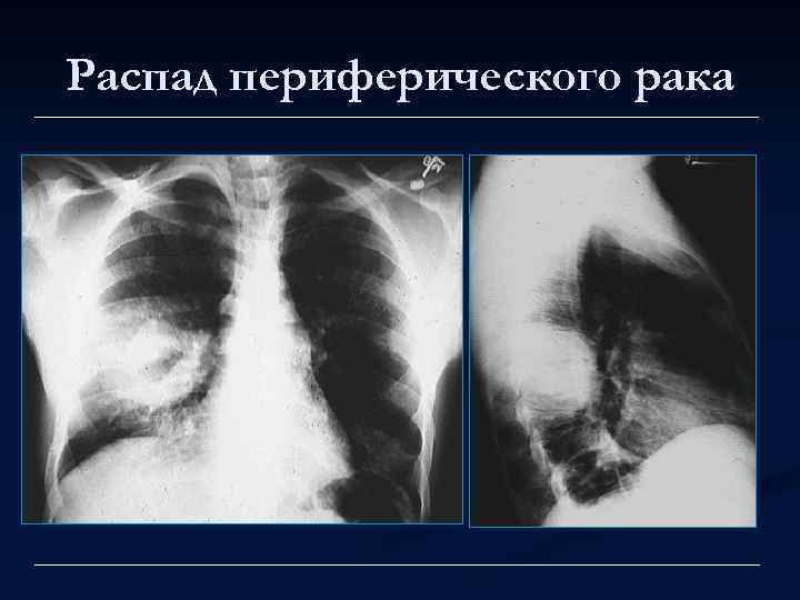 Распад периферического рака 