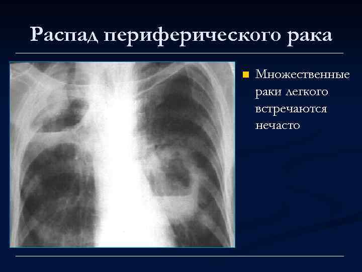 Распад периферического рака n Множественные раки легкого встречаются нечасто 