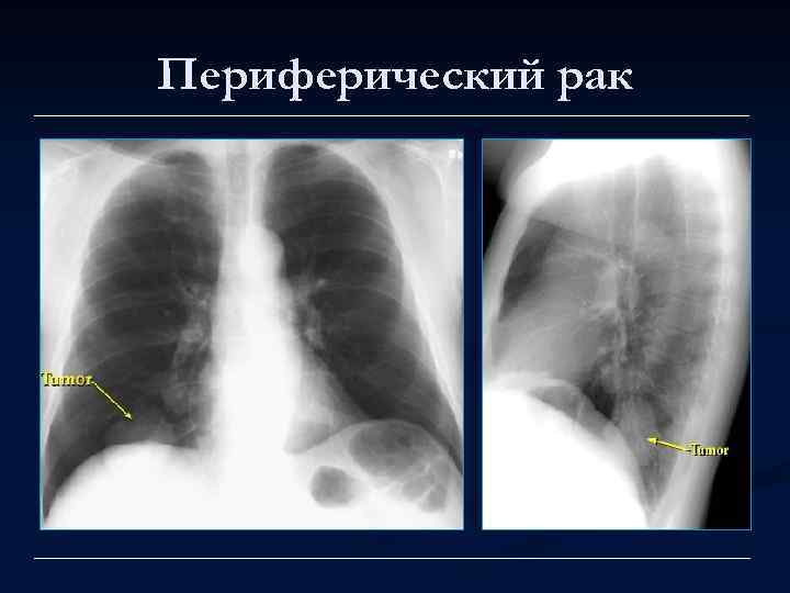 Периферический рак 