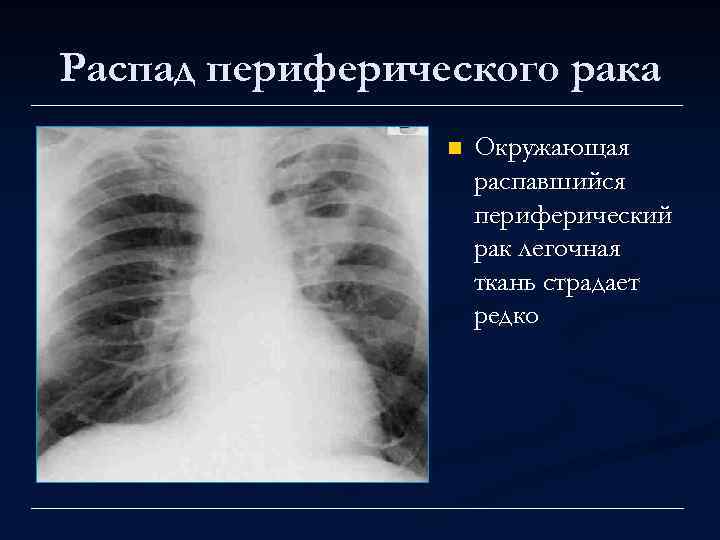 Распад периферического рака n Окружающая распавшийся периферический рак легочная ткань страдает редко 