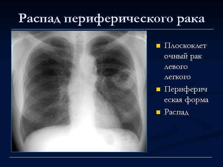 Распад периферического рака n n n Плоскоклет очный рак левого легкого Периферич еская форма