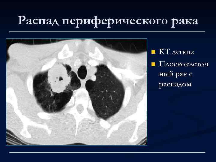 Распад периферического рака n n КТ легких Плоскоклеточ ный рак с распадом 