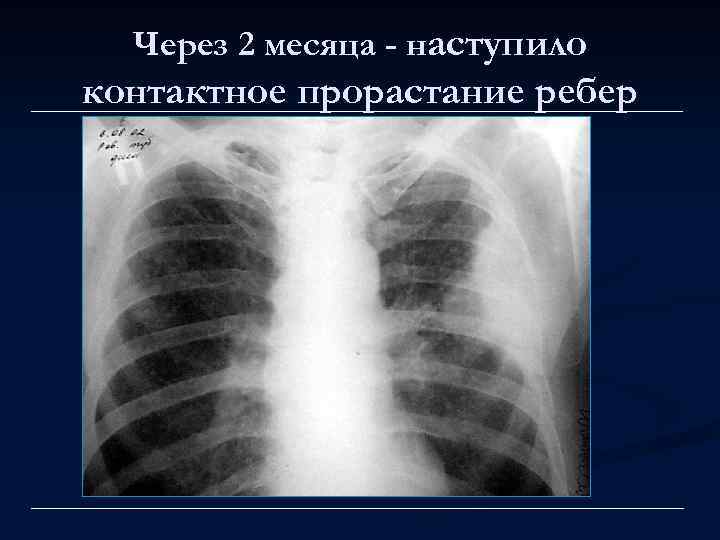 Через 2 месяца - наступило контактное прорастание ребер 
