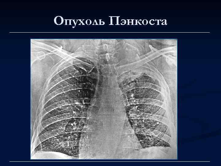 Опухоль Пэнкоста 