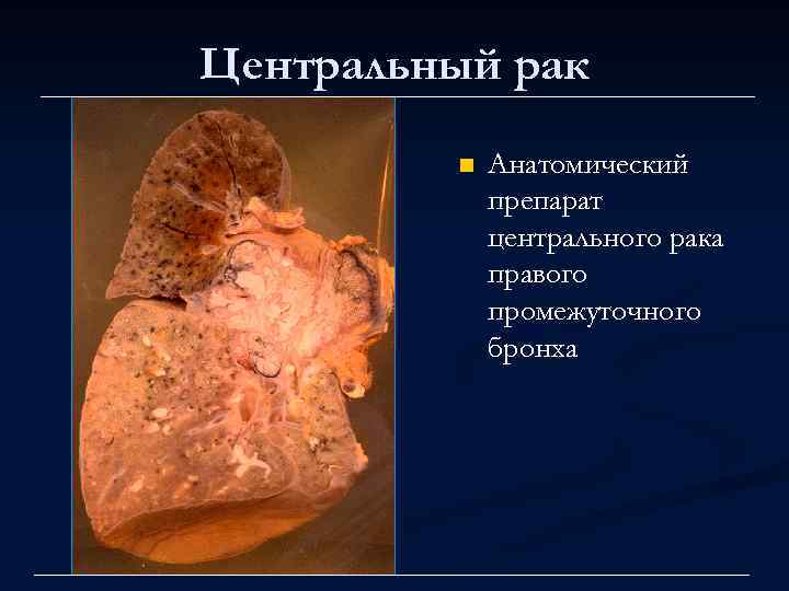 Центральный рак n Анатомический препарат центрального рака правого промежуточного бронха 