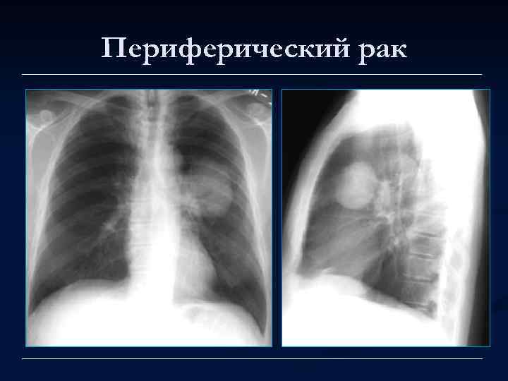 Периферический рак 