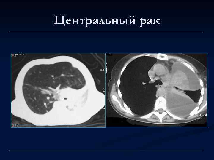 Центральный рак 