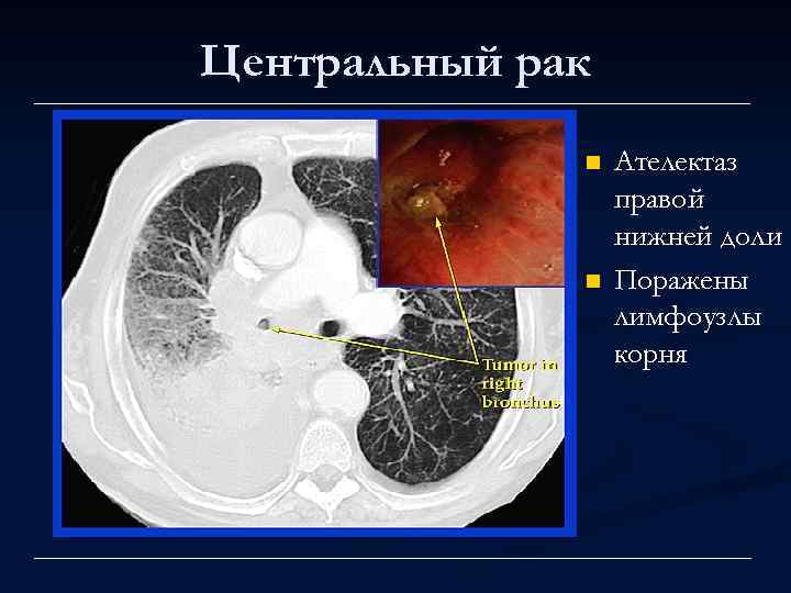 Центральный рак n n Ателектаз правой нижней доли Поражены лимфоузлы корня 