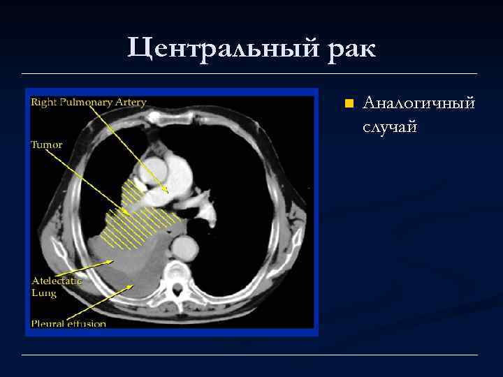 Центральный рак n Аналогичный случай 