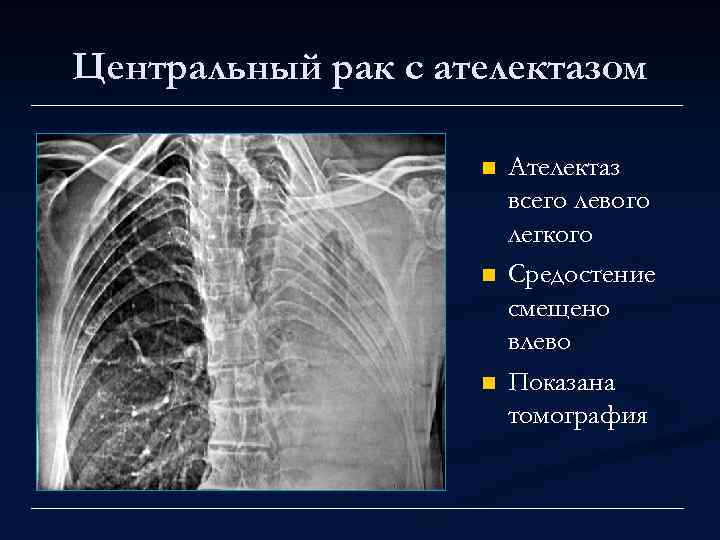 Центральный рак с ателектазом n n n Ателектаз всего левого легкого Средостение смещено влево