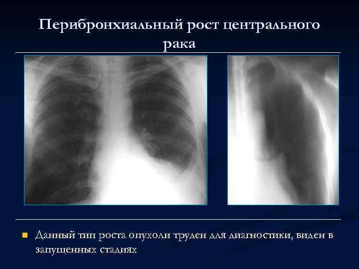Перибронхиальный рост центрального рака n Данный тип роста опухоли труден для диагностики, виден в