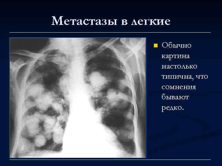 Метастазы в легкие n Обычно картина настолько типична, что сомнения бывают редко. 