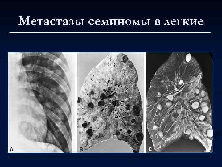 Метастазы семиномы в легкие 