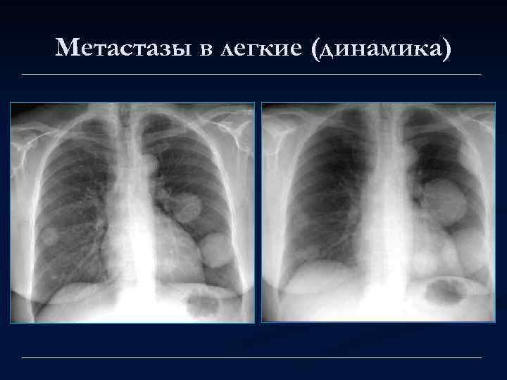 Метастазы в легкие (динамика) 