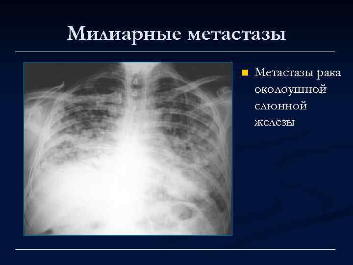 Милиарные метастазы n Метастазы рака околоушной слюнной железы 