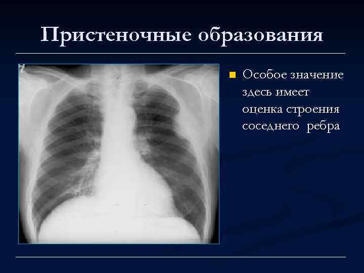 Пристеночные образования n Особое значение здесь имеет оценка строения соседнего ребра 