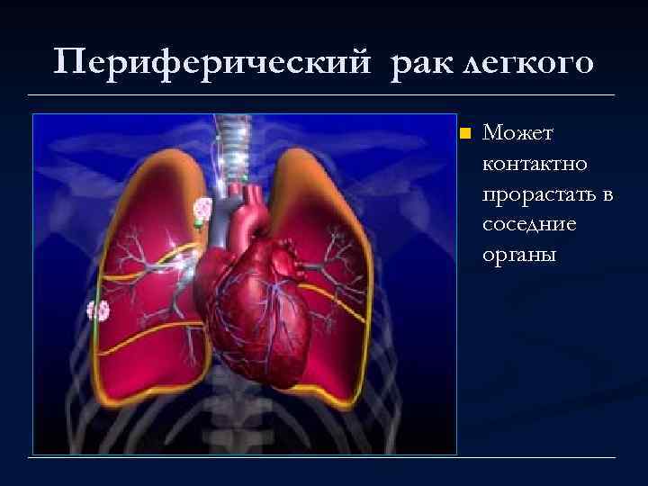 Периферический рак легкого n Может контактно прорастать в соседние органы 