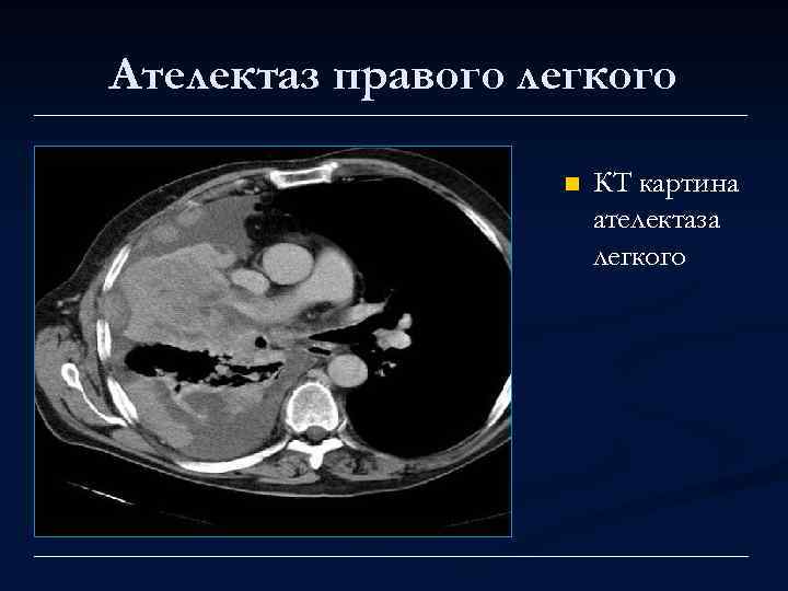 Ателектаз правого легкого n КТ картина ателектаза легкого 