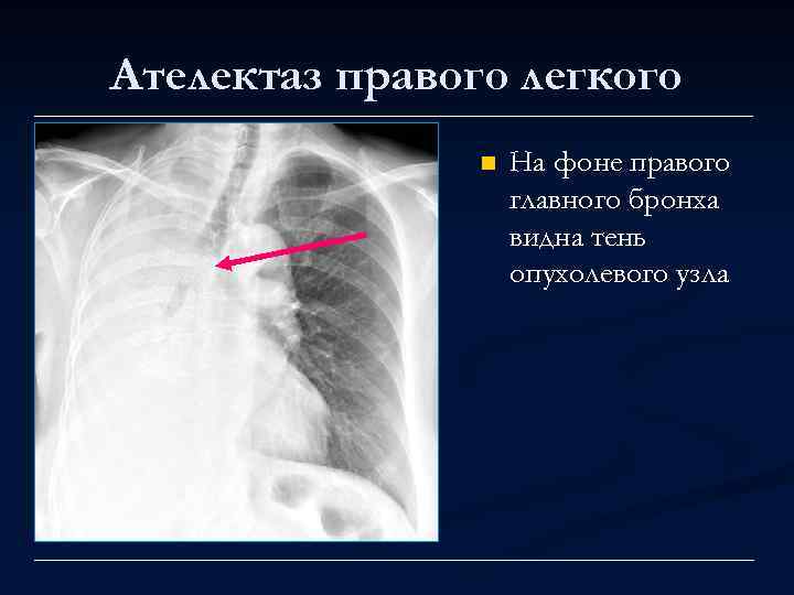 Ателектаз правого легкого n На фоне правого главного бронха видна тень опухолевого узла 