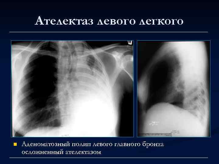 Ателектаз левого легкого n Аденоматозный полип левого главного бронха осложненный ателектазом 